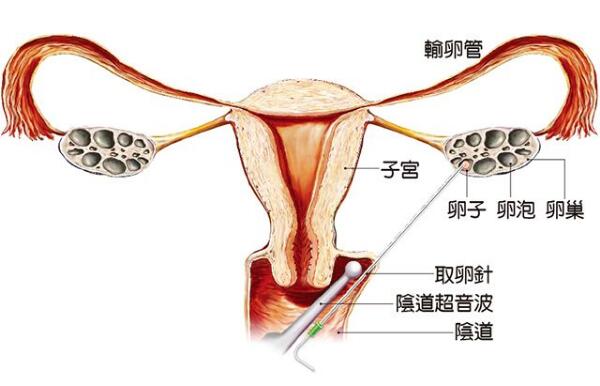 剖腹产